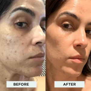 tca chemical peel